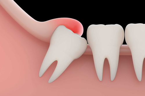 3rd Molar Extraction
